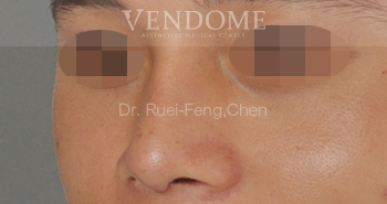 img_BA_nose surgery 10 img_BA_nose surgery 10